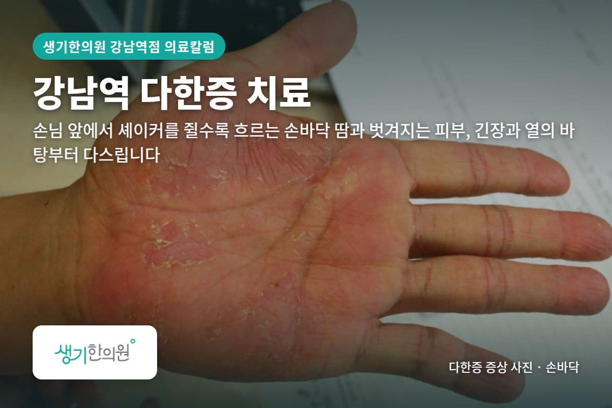 손바닥 다한증 증상 사진과 문구 「강남역 다한증 치료, 손님 앞에서 셰이커를 쥘수록 흐르는 손바닥 땀과 벗겨지는 피부, 긴장과 열의 바탕부터 다스립니다 · 생기한의원 강남역점」