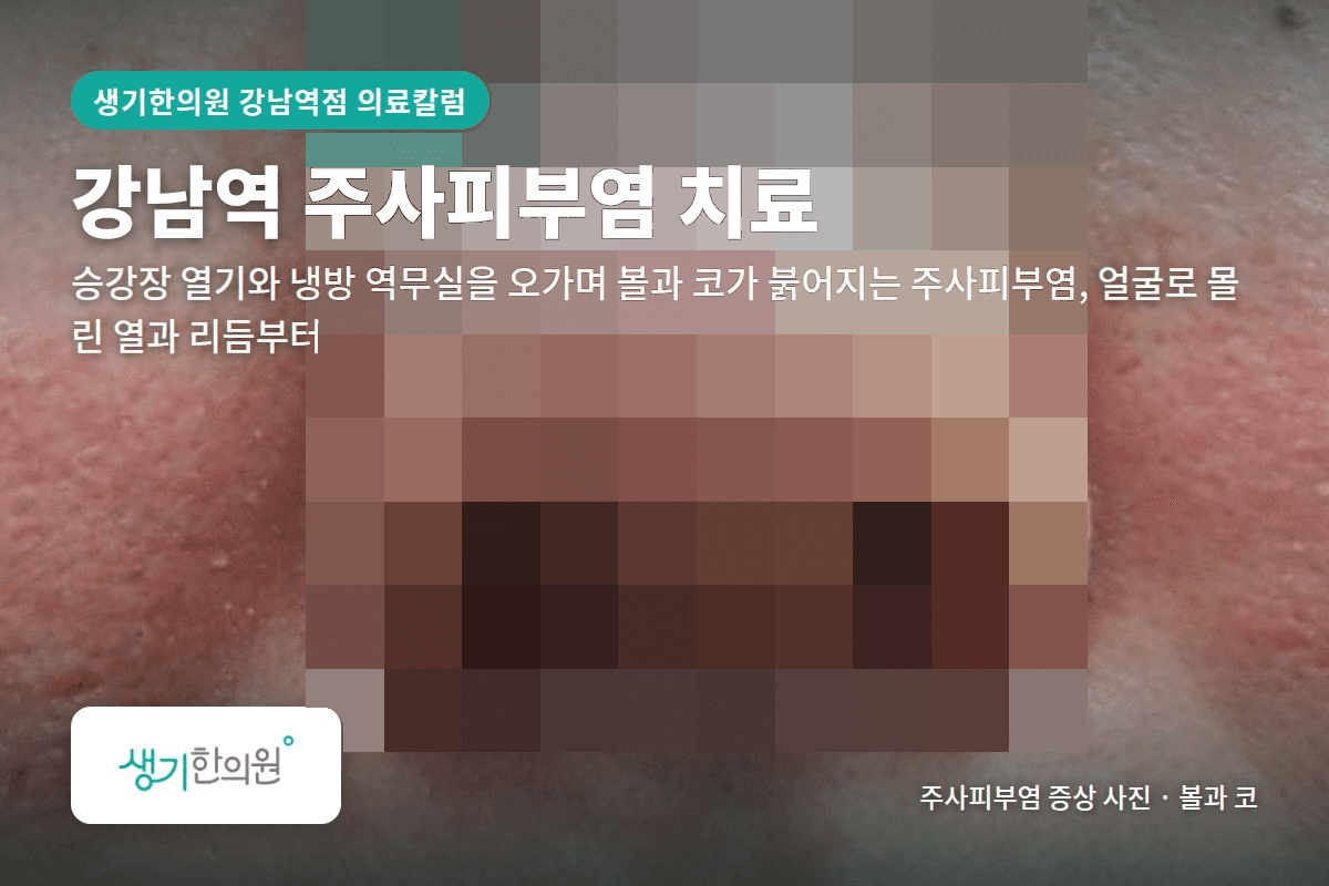 볼과 코 주사피부염 증상 사진과 문구 「강남역 주사피부염 치료, 승강장 열기와 냉방 역무실을 오가며 볼과 코가 붉어지는 주사피부염, 얼굴로 몰린 열과 리듬부터 · 생기한의원 강남역점」